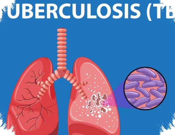 Garut Dihantui Tuberkulosis, 3.939 Kasus Terkonfirmasi dan 20 Orang Meninggal