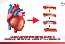 Lesi Bifurkasi Bikin Pemasangan Ring Jantung Lebih Rumit, Ini Penyebabnya