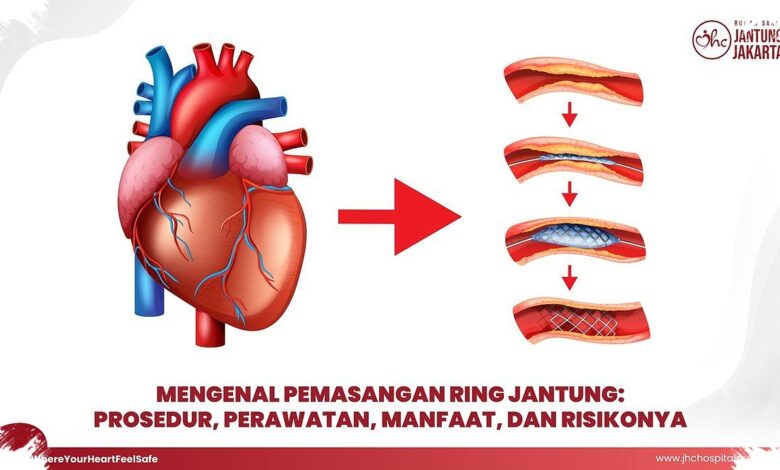 Lesi Bifurkasi Bikin Pemasangan Ring Jantung Lebih Rumit, Ini Penyebabnya