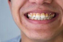 Penyakit Gusi Parah Bisa Jadi Sinyal Awal Kerusakan Ginjal, Ini Temuan Studinya