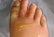 8 Tanda Tubuh Kelebihan Garam, dari Kaki Bengkak sampai Jantung Berdebar