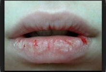 Bibir Makin Kering Setelah Lip Balm, 4 Bahan Ini Bisa Mengikis Pelindung Alaminya