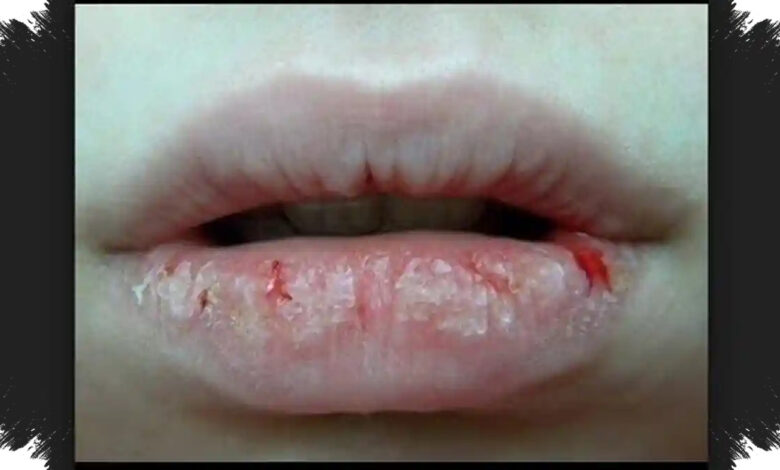 Bibir Makin Kering Setelah Lip Balm, 4 Bahan Ini Bisa Mengikis Pelindung Alaminya