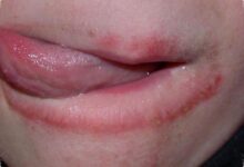 5 Kebiasaan yang Bisa Membantu Memutus Siklus Bibir Kering dan Pecah-Pecah