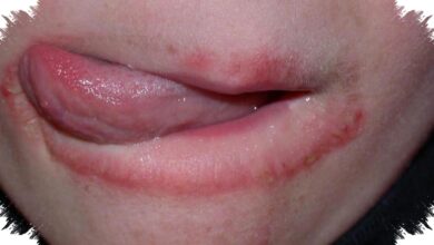5 Kebiasaan yang Bisa Membantu Memutus Siklus Bibir Kering dan Pecah-Pecah