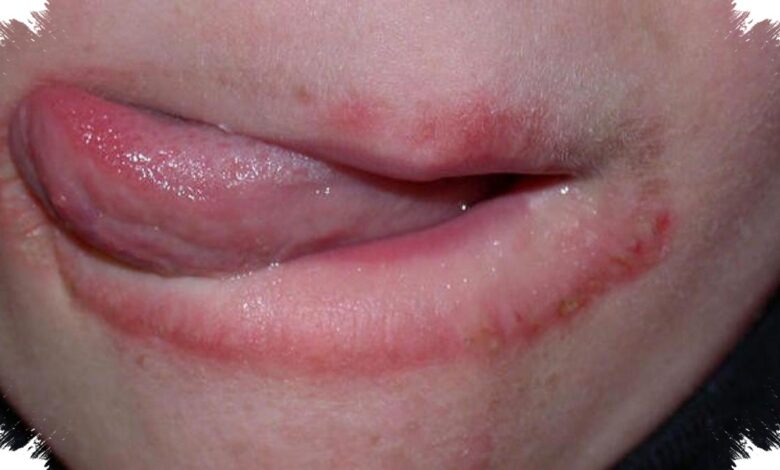 5 Kebiasaan yang Bisa Membantu Memutus Siklus Bibir Kering dan Pecah-Pecah