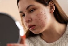 NaCl 0,9 Persen Terasa Aman di Wajah, tetapi Tak Terbukti Mengatasi Jerawat
