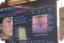 Melasma Mudah Kambuh di Kulit Tropis, Sinar Matahari Bukan Satu-Satunya Pemicu